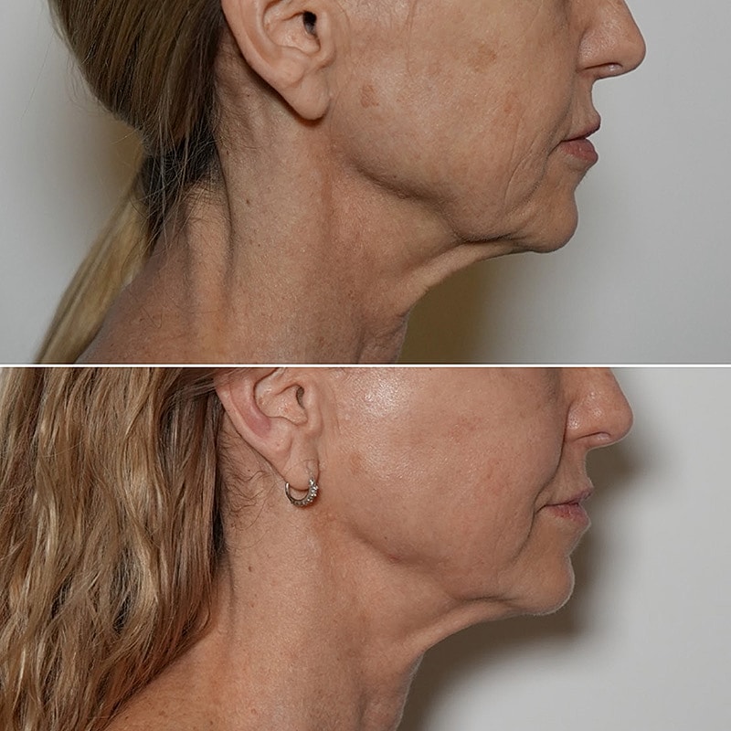 XERF Skin Tightening Before & After