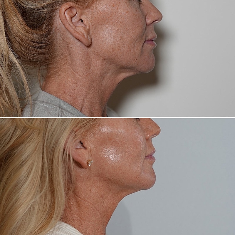 XERF Skin Tightening Before & After