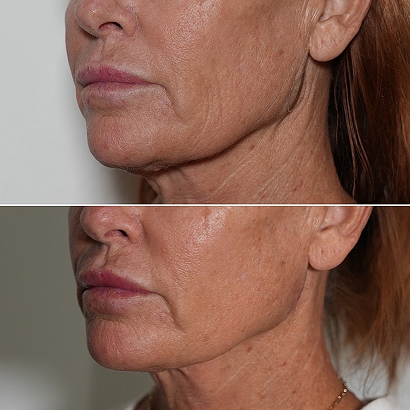 XERF Skin Tightening Before & After