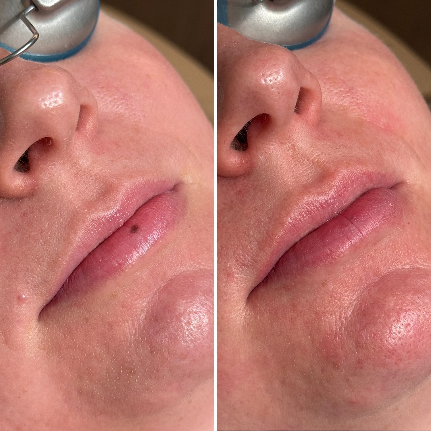 Laser Services Before & After
