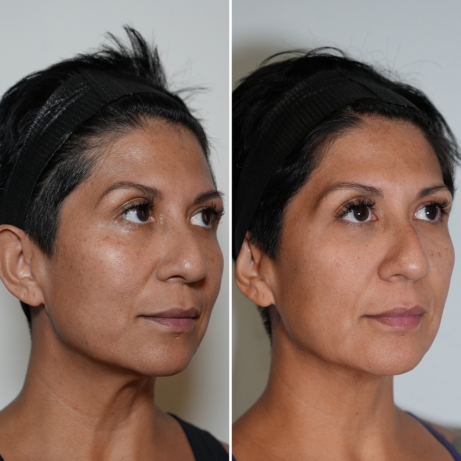 Laser Services Before & After