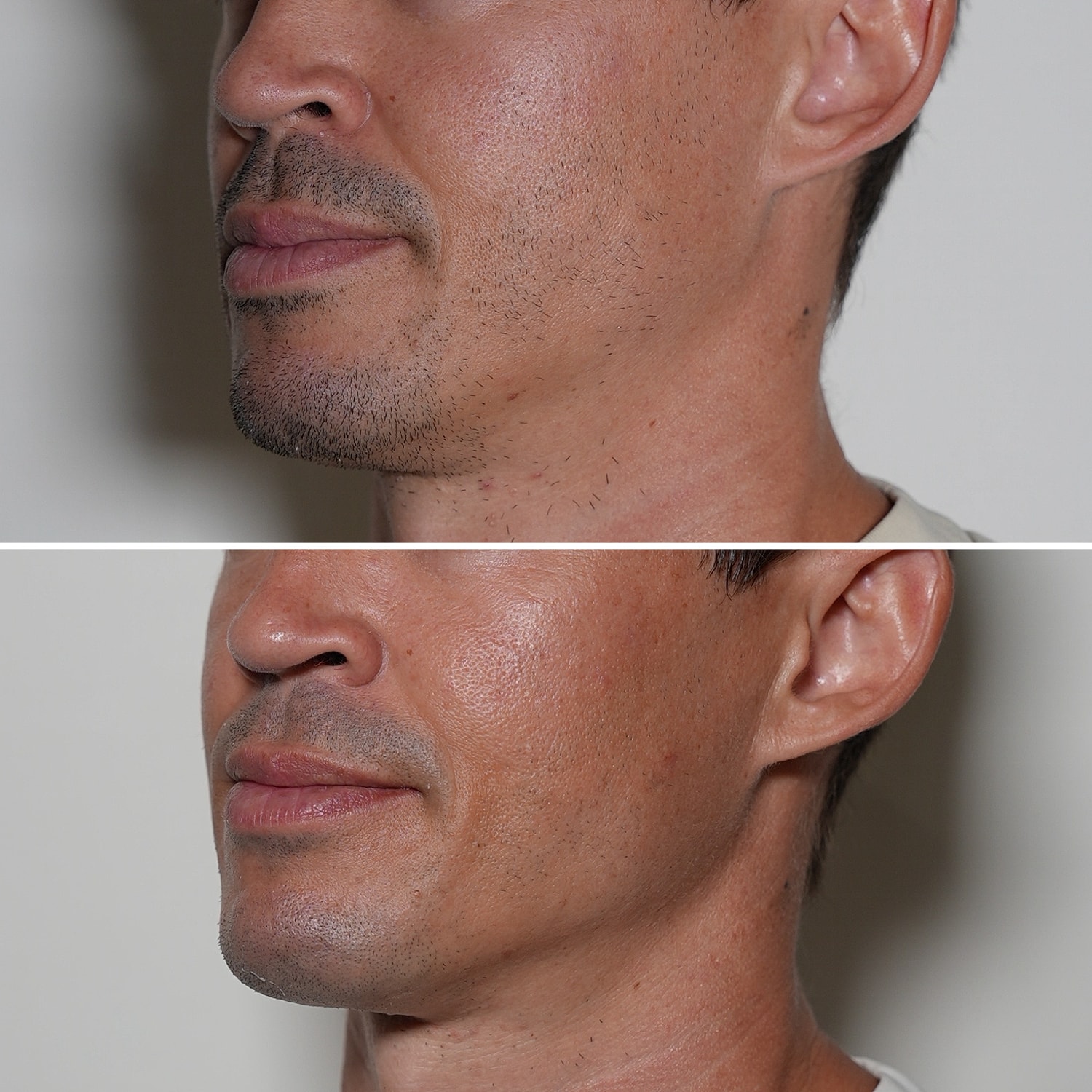 Laser Services Before & After