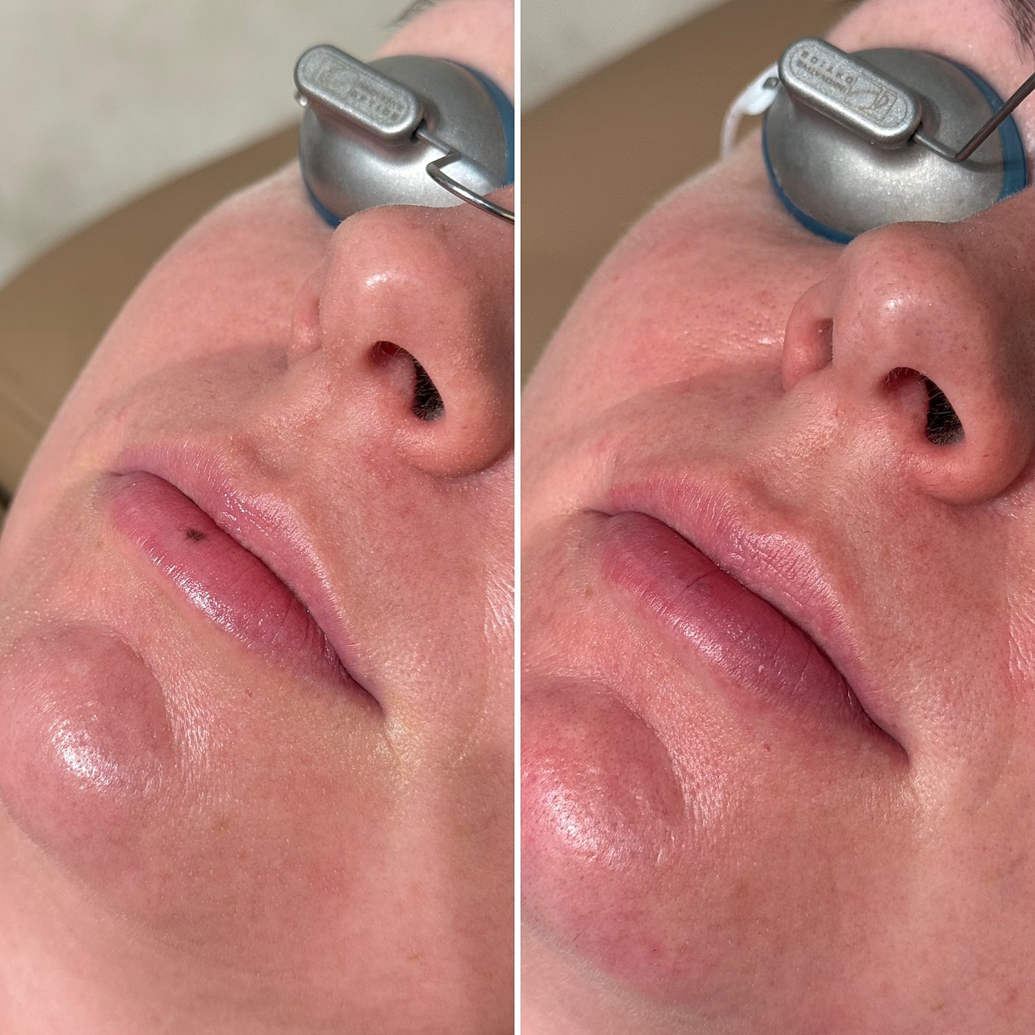 Laser Services  Before & After