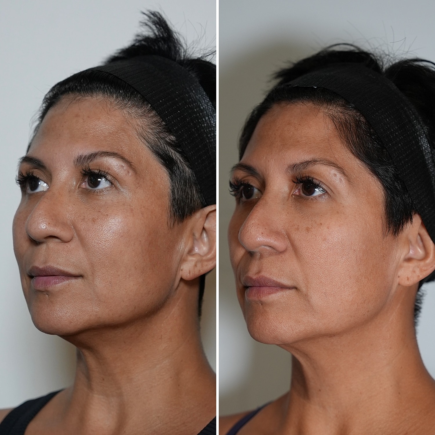 Laser Services Before & After