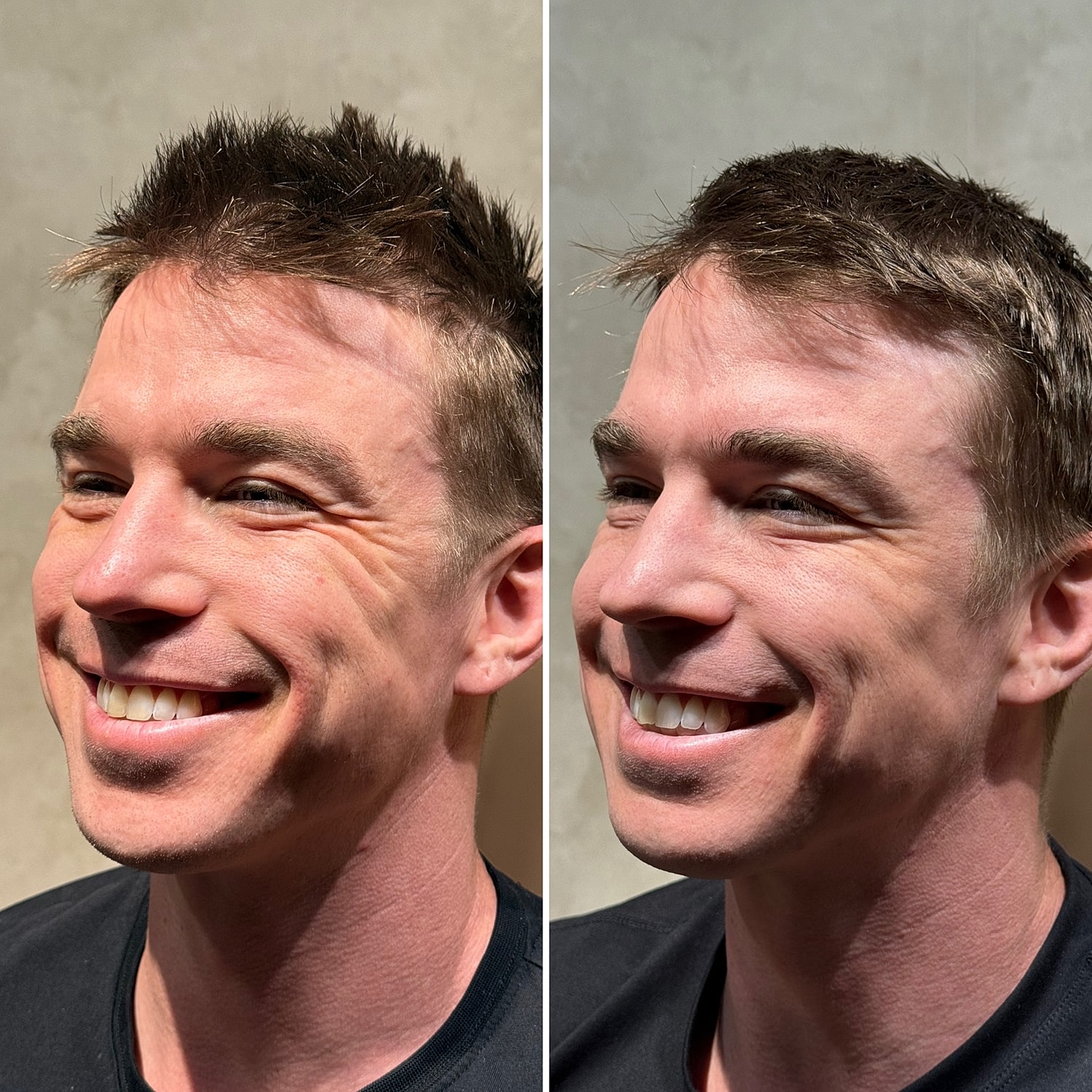 Botox, Xeomin, Daxxify Before & After