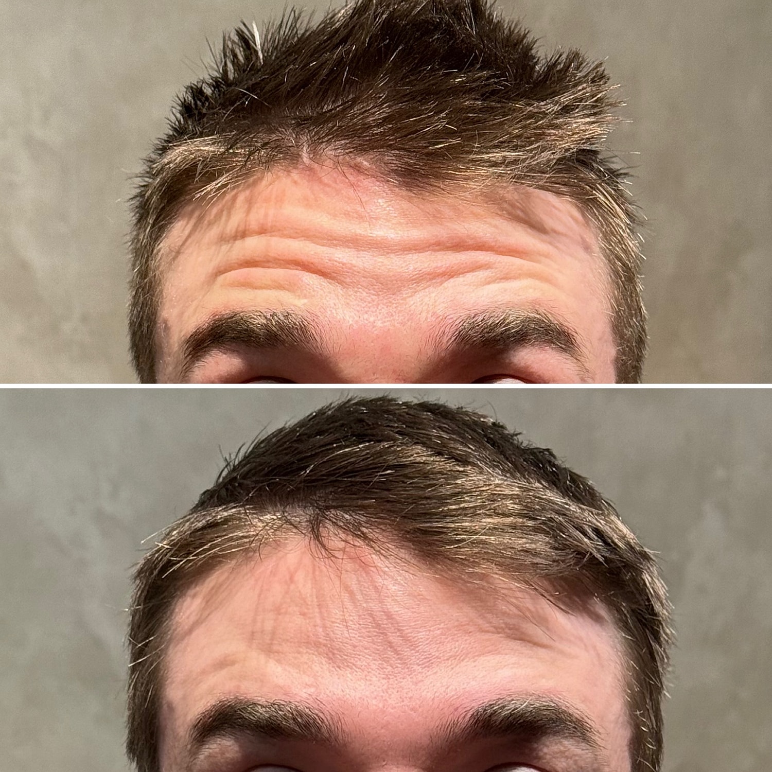 Botox, Xeomin, Daxxify Before & After