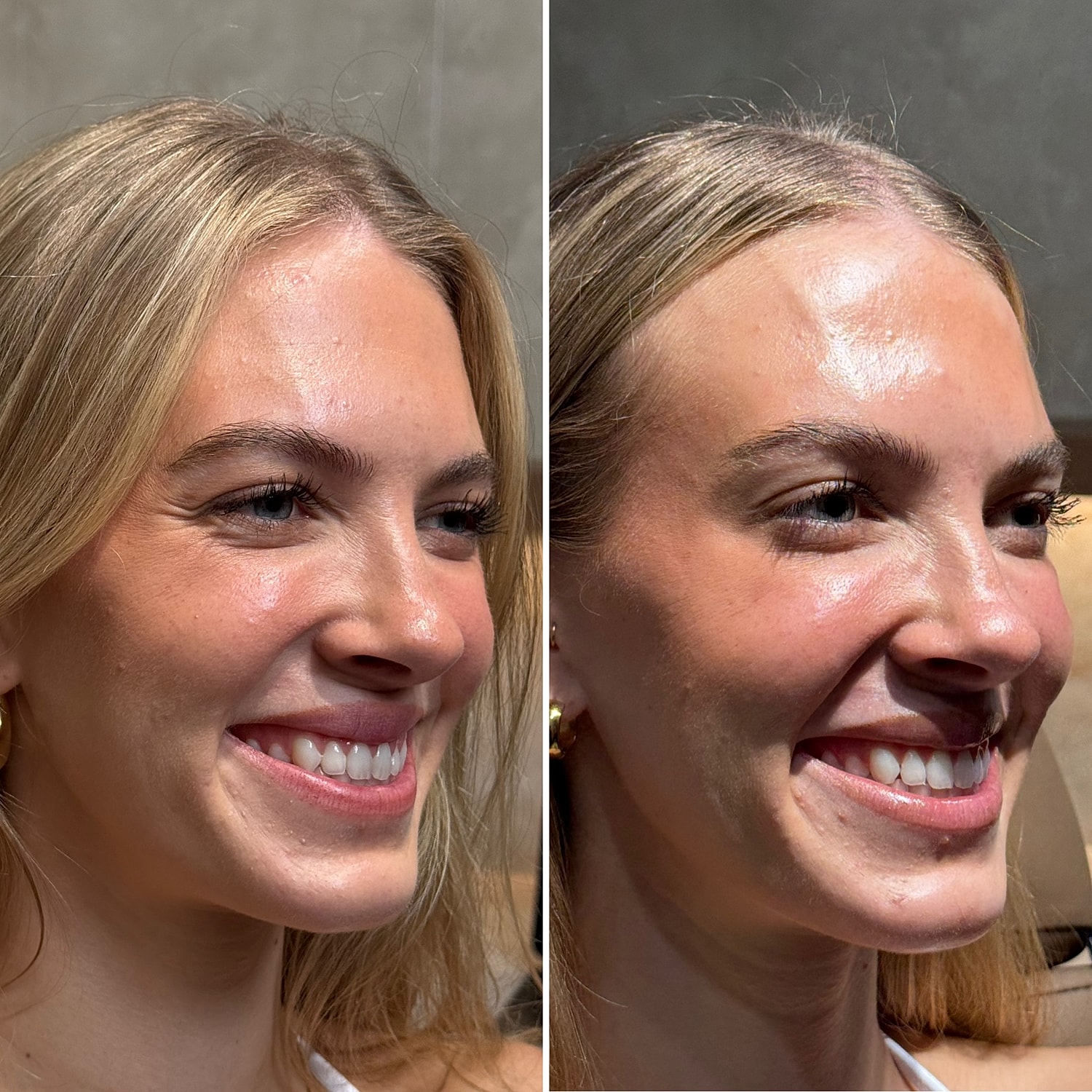 Botox, Xeomin, Daxxify Before & After