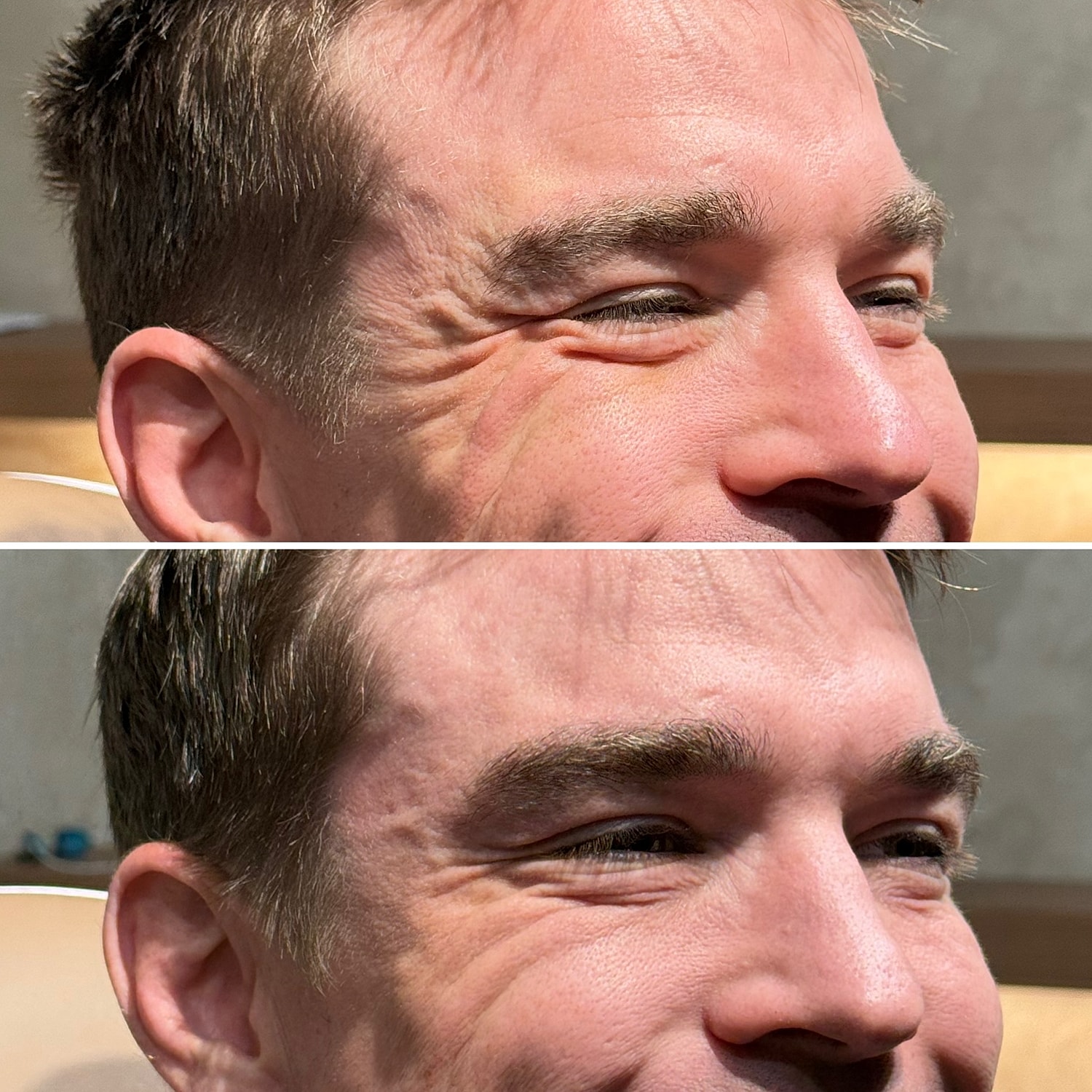 Botox, Xeomin, Daxxify Before & After