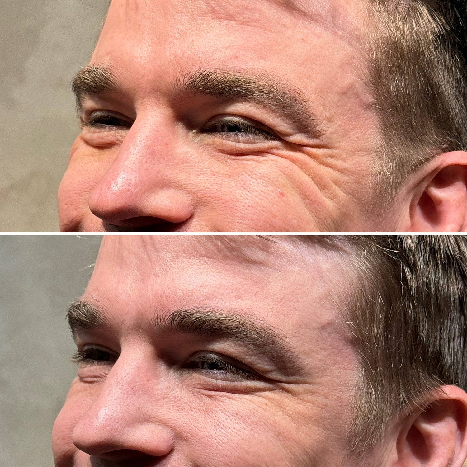 Botox, Xeomin, Daxxify Before & After