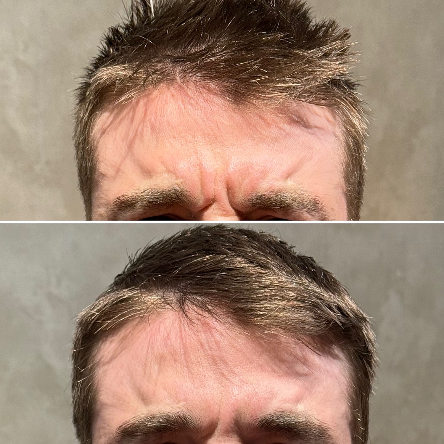 Botox, Xeomin, Daxxify Before & After