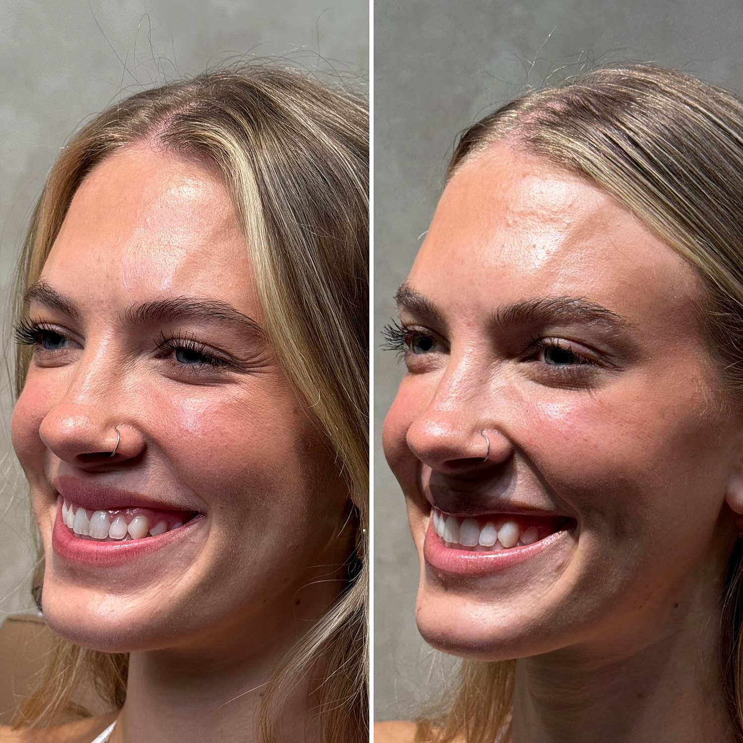 Botox, Xeomin, Daxxify Before & After