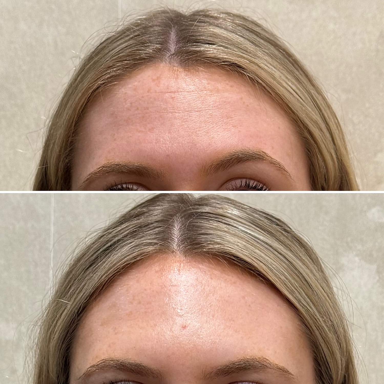 Botox, Xeomin, Daxxify Before & After
