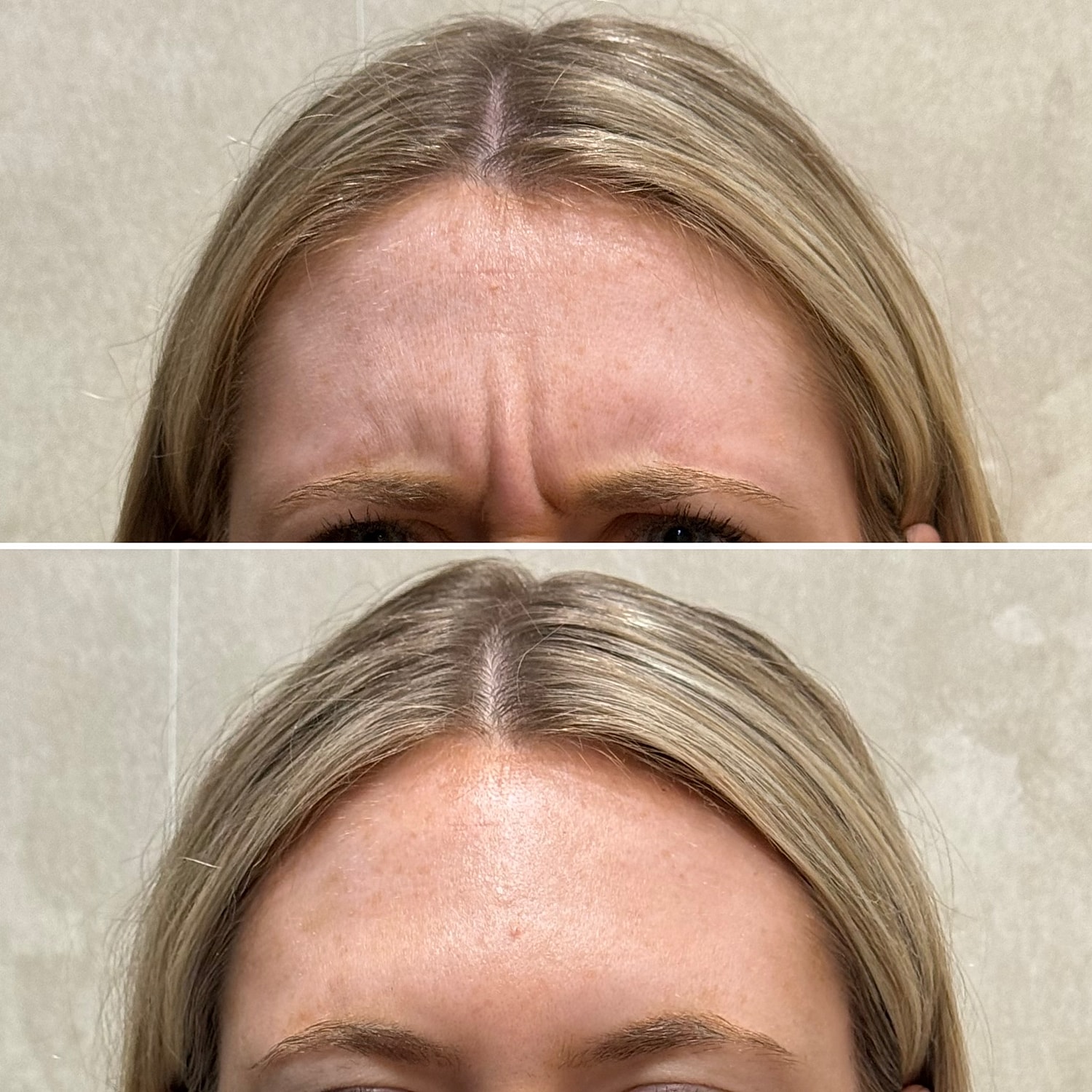 Botox, Xeomin, Daxxify Before & After