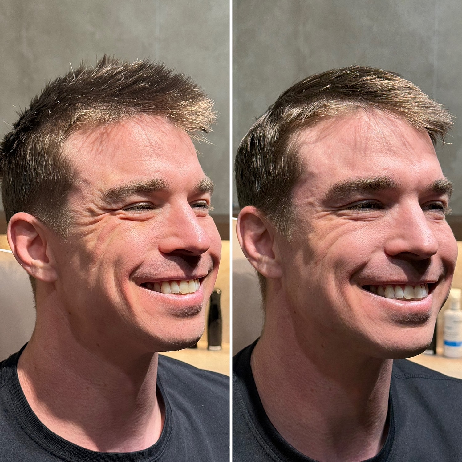 Botox, Xeomin, Daxxify Before & After