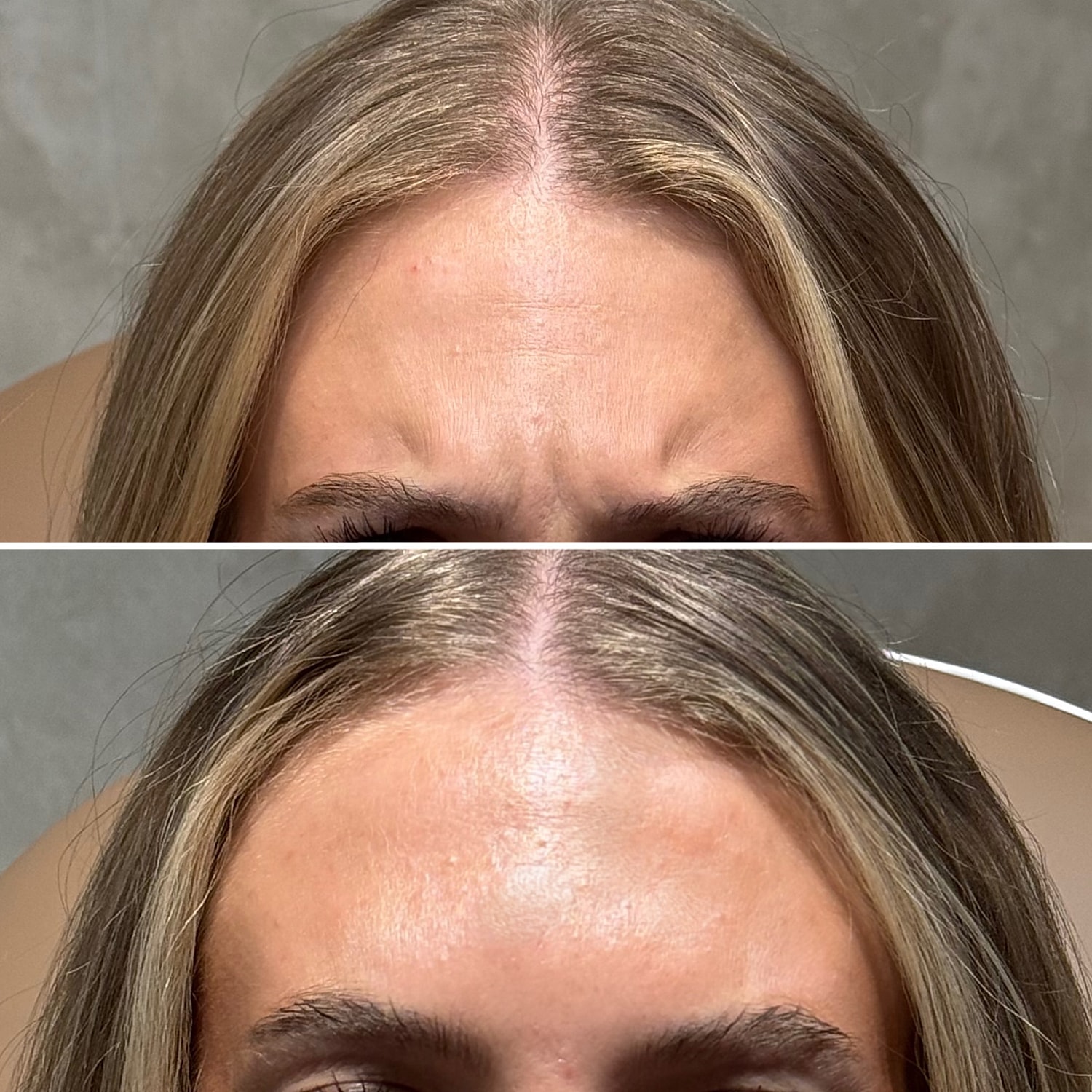 Botox, Xeomin, Daxxify Before & After