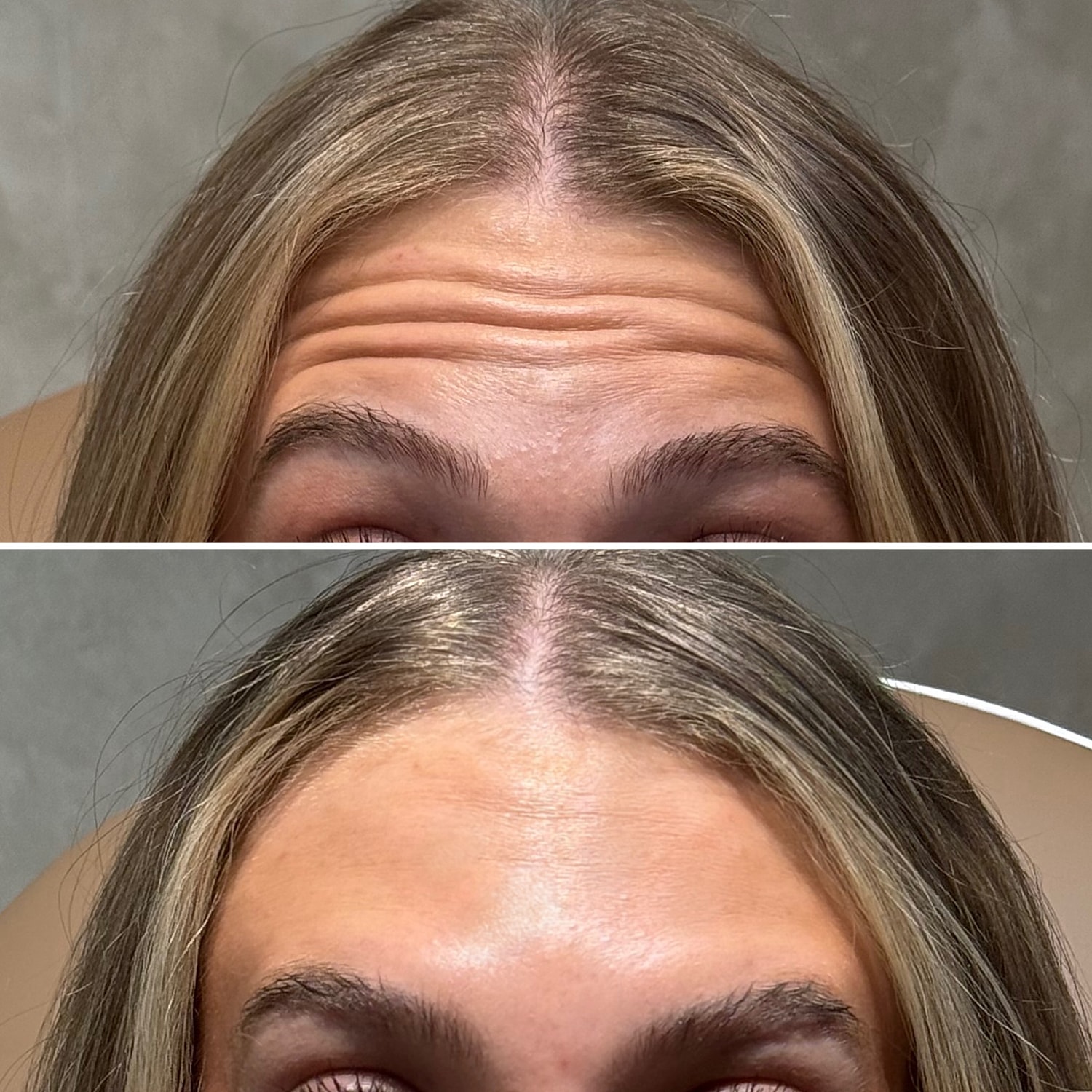 Botox, Xeomin, Daxxify Before & After