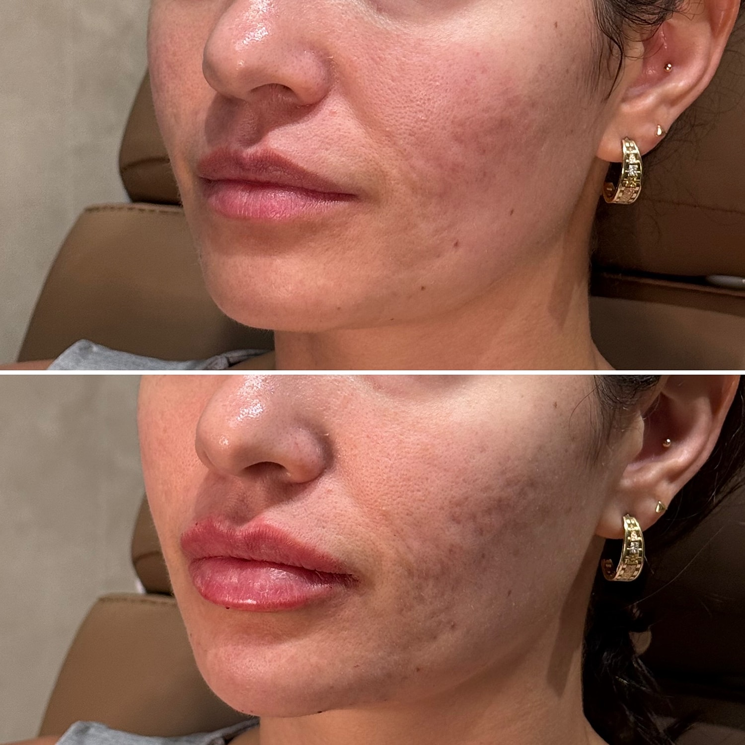 Dermal Fillers Before & After