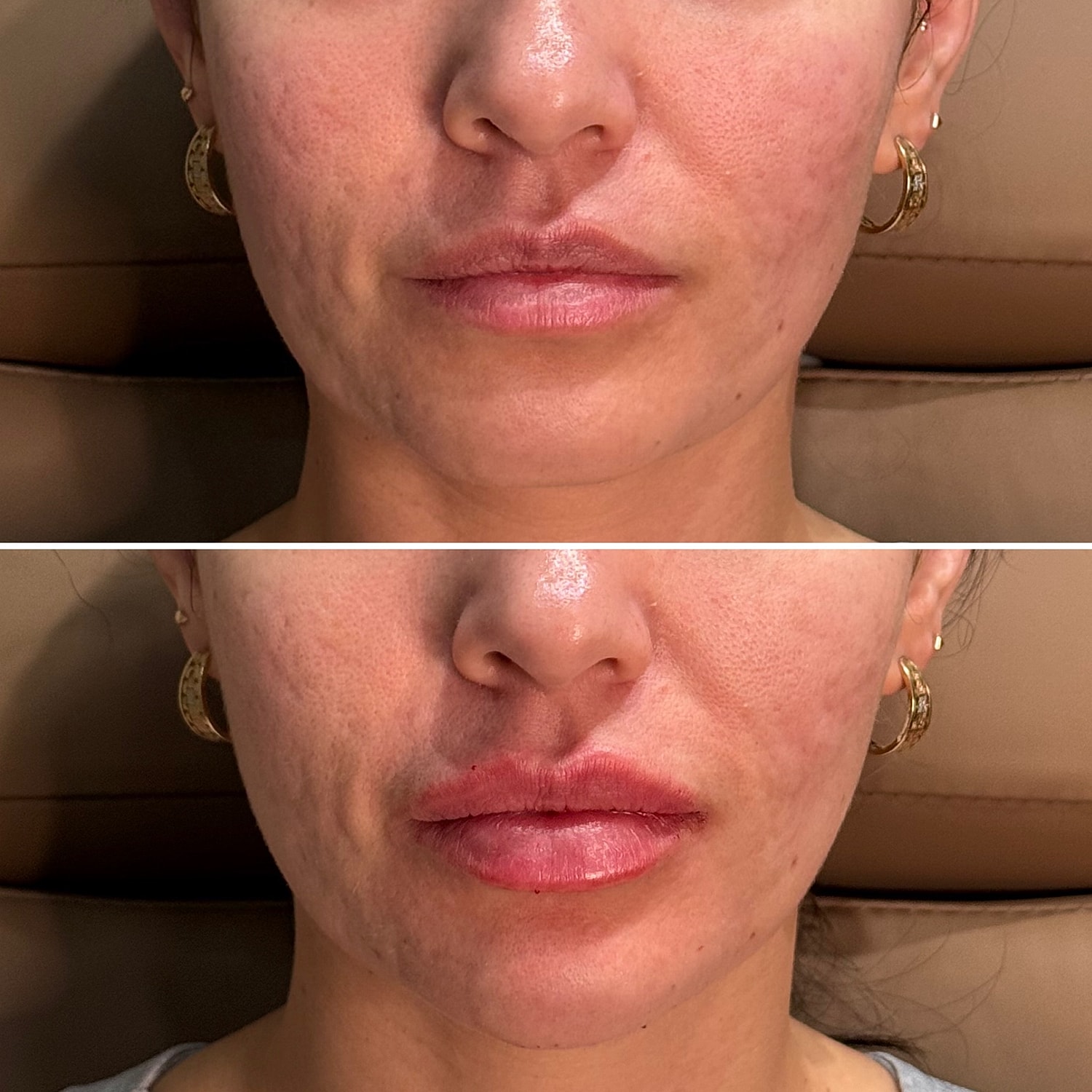 Dermal Fillers Before & After