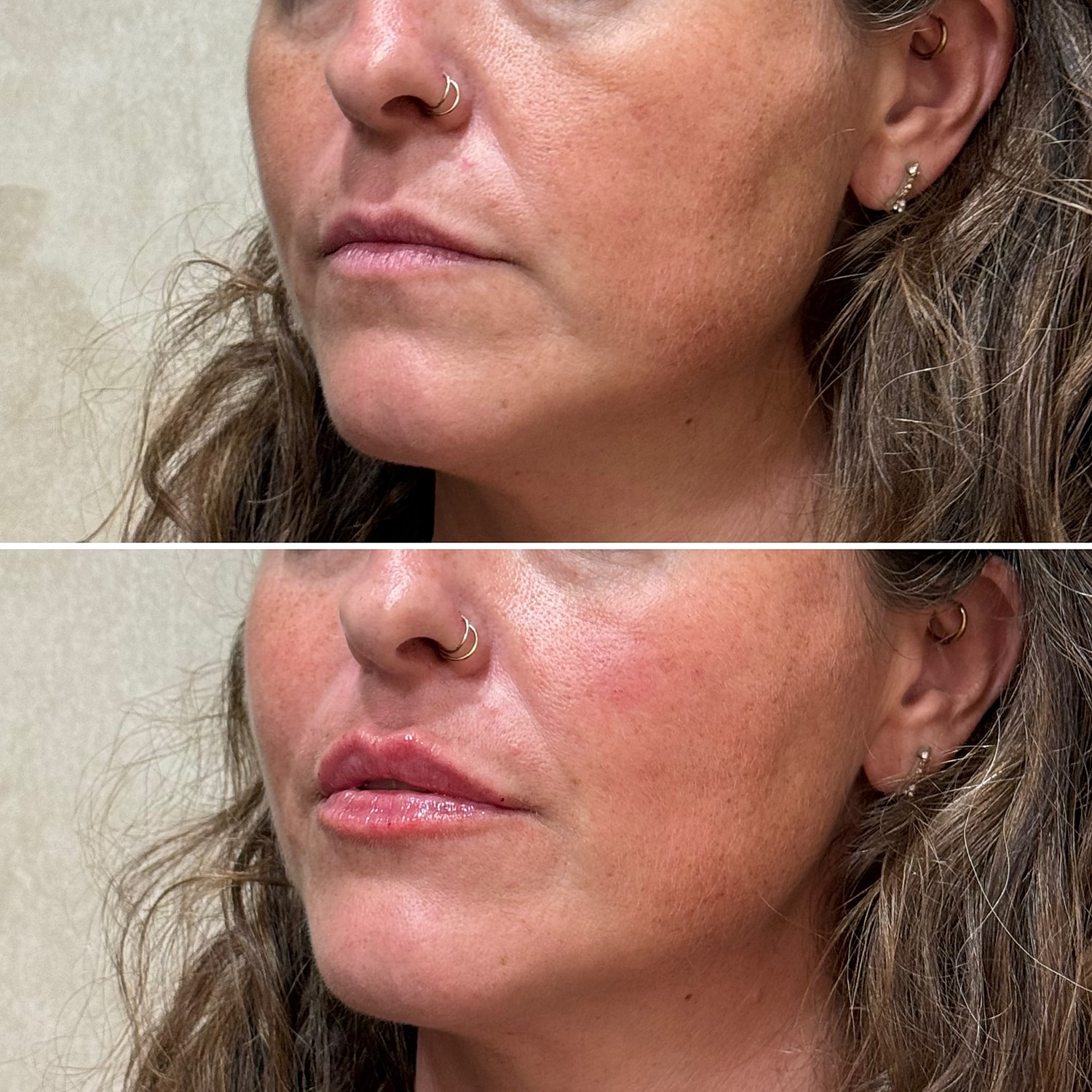 Dermal Fillers Before & After