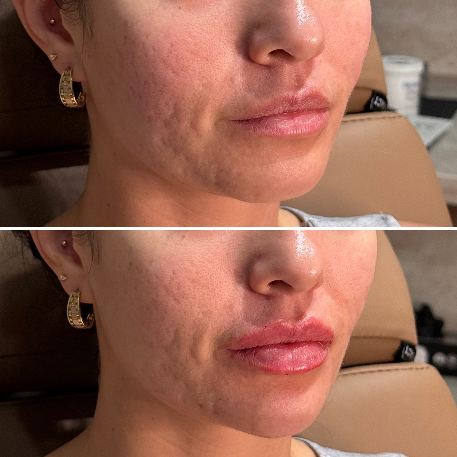 Dermal Fillers Before & After