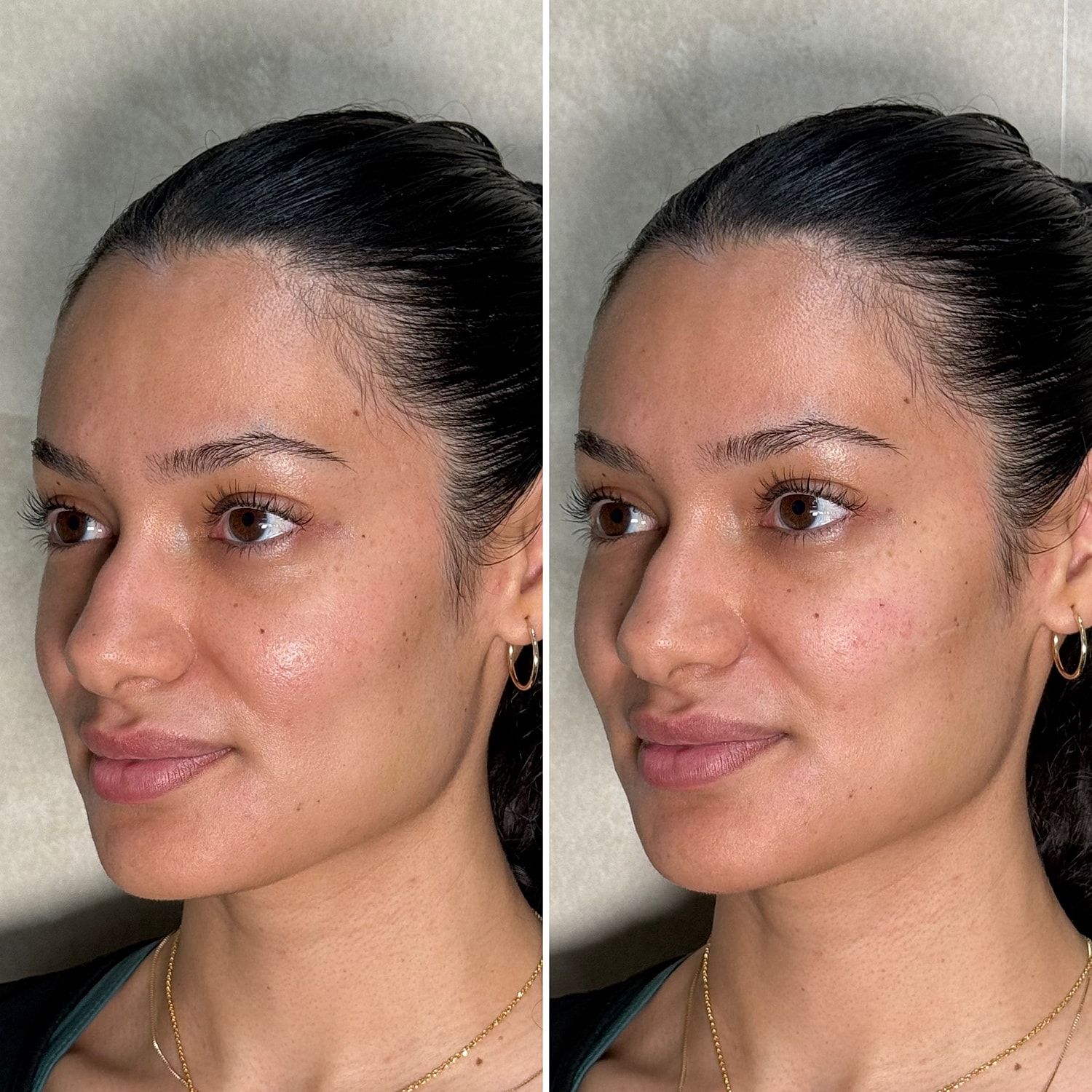 Dermal Fillers Before & After