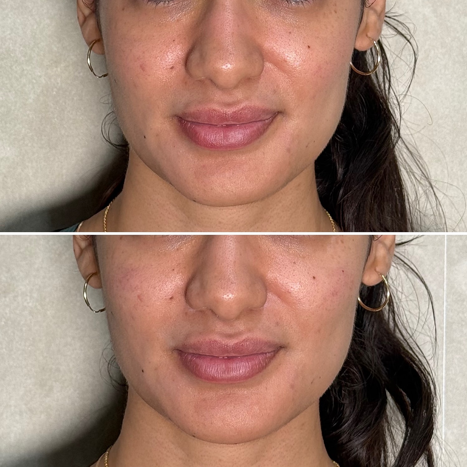 Dermal Fillers Before & After